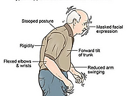 iframely: Correcting a Stoop: Understanding, Prevention, and Remedies