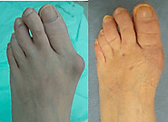 ¡Ayuda, por favor! ¿Cómo curar los juanetes de los pies?