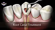 Root Canal Treatment Versus Tooth Extraction – Which You Should Choose