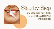 Step-by-Step Overview of the Gum Bleaching Process - Binbex