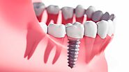 Diverse Dental Implant Options with All Smiles Dentistry in Allen