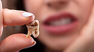 How to Prepare for Wisdom Teeth Removal in Allen, TX
