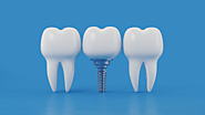 Maintaining Oral Health After Getting Dental Implants in Allen