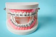 Foods to Enjoy and Avoid For Patients With Braces | Wyatt Orthodontics