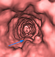 Laryngeal papillomatosis - Wikipedia