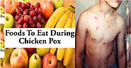 Chicken Pox Diet | আবহাওয়ার পরিবর্তনে চিন্তা বাড়াচ্ছে চিকেন পক্স! জানুন দ্রুত সুস্থ্য হতে কী খাবেন?