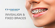 Fixed Braces & Invisalign in Surrey | Orthodontics Treatment