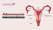 Adenomyosis: Cause, Symptoms, Diagnosis and Treatment