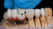 Dental Crowns vs. Dental Fillings: Which is Right for You?