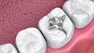 What You Should Know Before Getting a Dental Filling?