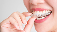 What to Expect During Your Invisalign Treatment Journey?