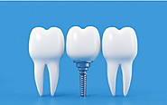 Dental Implants for Seniors: Breaking Down Age Restrictions