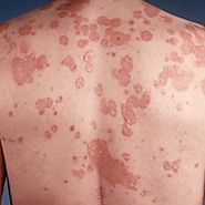 Treatment for psoriasis