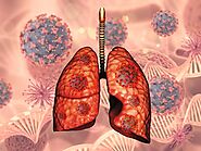 Lung Cancer: Early Detection and Treatment Options Offered by Pulmonologists