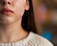 Why Shouldn’t Acne Be Picked Up?