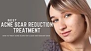 How To Treat Acne Scars For Clear And Radiant Skin?