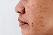 How do you fix pigmentation on your nose?