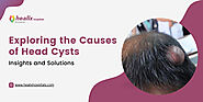 Understanding Head Cysts: Causes and Solutions - Healix Hospitals