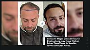 Hair Transplant Costs In Turkey