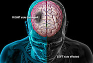 Brain Stroke Treatment in Pune - Dr. Sachin Mahajan