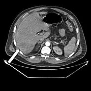 Lactococcus lactis endocarditis and liver abscess in an immunocompetent patient: a case report and review of the lite...