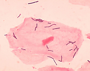 Lactobacillus as a Pathogen?