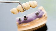 3 Things to Know Before Considering a Dental Bridge