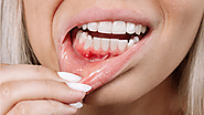 How to Prevent Gum Disease?