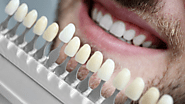 5 Reasons to Consider Dental Veneers