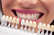 Veneers vs. Braces: Which Is the Right Choice for You?