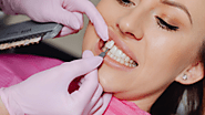 How To Maintain Your Veneers for Long-Lasting Results?