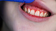 How to Spot Signs of Gum Disease