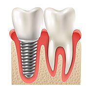 Dental Implants: Everything You Need To Know – Perdido Bay Dental