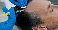 The Ultimate Guide to Treating Alopecia: Effective Home Remedies and Professional Options