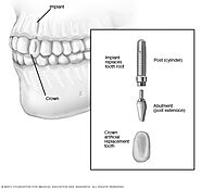 Dental implant surgery - Mayo Clinic