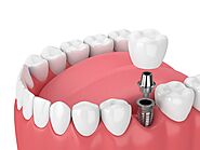 4 Types of Dental Implants (Procedure, Costs, Pros & Cons)