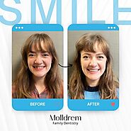 Implant Innovations: Kevin Molldrem Dental Implants Revolutionize Smiles Across Social Media!