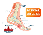 Walk Pain-Free: Stylish Solutions for Plantar Fasciitis