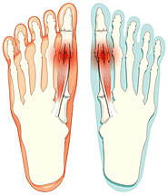 Bunion Pain Relief: Choosing the Right Footwear
