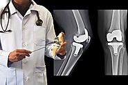 Is there an alternative to Knee Replacement Surgery?