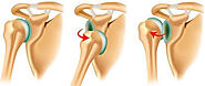 Total Shoulder Replacement and Reverse Shoulder Replacement Surgery Delhi, India