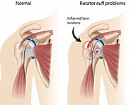 Total Shoulder Replacement and Reverse Shoulder Replacement Surgery Delhi, India