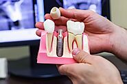 Dental Implants in Coimbatore | Tooth Transplant Cost