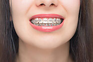 Orthodontic Treatment | Teeth Braces Clear Aligners
