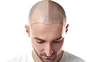 For Your Hair Transplant Surgery in Delhi, Choose Dr. Sachin Rajpal: The Finest Cosmetic Surgeon In Delhi