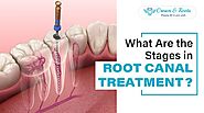 What Are the Stages in Root Canal Treatment?