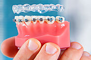 Invisible Aligners or Metal Wires? The Choice for Straight Teeth