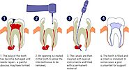 Painless RCT in Delhi, Root Canal Treatment Cost in Delhi, Single Sitting RCT South Delhi - Crown & Roots