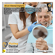 Affordable and Best Quality Dental Implants in Hyderabad