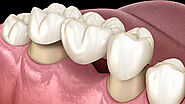 Top 5 Benefits of a Dental Crown